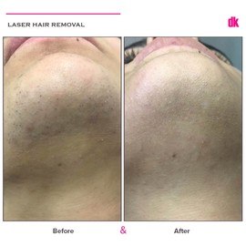 LASER HAIR REMOVAL - Female - Before and After