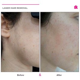 LASER HAIR REMOVAL - Female - Before and After