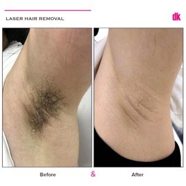 LASER HAIR REMOVAL - Female - Before and After
