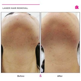 LASER HAIR REMOVAL - Female - Before and After