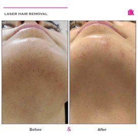 LASER HAIR REMOVAL - Female - Before and After