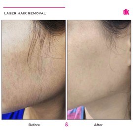 LASER HAIR REMOVAL - Female - Before and After