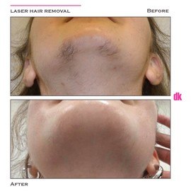 LASER HAIR REMOVAL - Female - Before and After