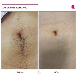 LASER HAIR REMOVAL - Female - Before and After