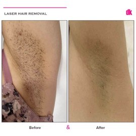 LASER HAIR REMOVAL - Female - Before and After