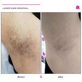 LASER HAIR REMOVAL - Female - Before and After