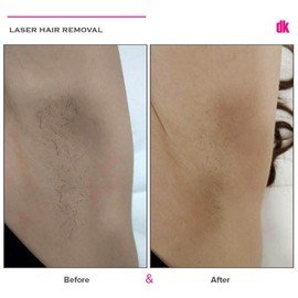 LASER HAIR REMOVAL - Female - Before and After