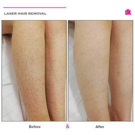 LASER HAIR REMOVAL - Female - Before and After