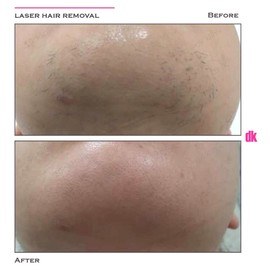 LASER HAIR REMOVAL - Female - Before and After