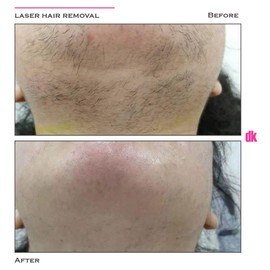 LASER HAIR REMOVAL - Female - Before and After