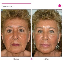 THREAD LIFT - Before and After