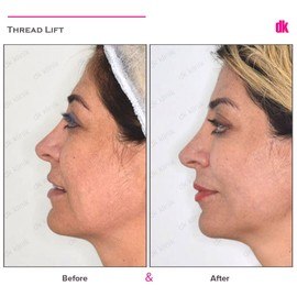 THREAD LIFT - Before and After