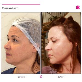 THREAD LIFT - Before and After