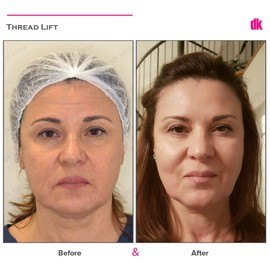THREAD LIFT - Before and After