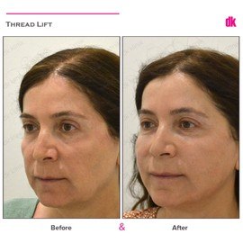 THREAD LIFT - Before and After