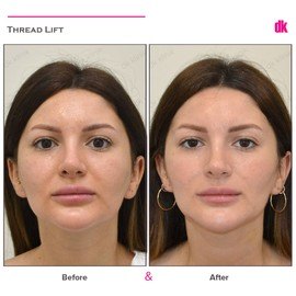 THREAD LIFT - Before and After