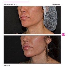 THREAD LIFT - Before and After