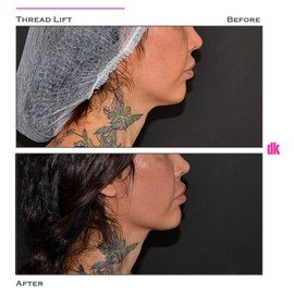 THREAD LIFT - Before and After