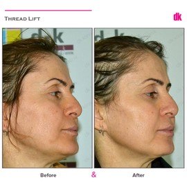 THREAD LIFT - Before and After