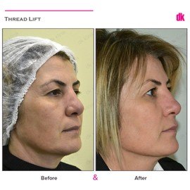 THREAD LIFT - Before and After