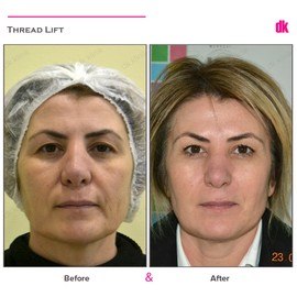 THREAD LIFT - Before and After