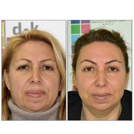 THREAD LIFT - Before and After