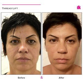 THREAD LIFT - Before and After