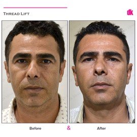 THREAD LIFT - Before and After