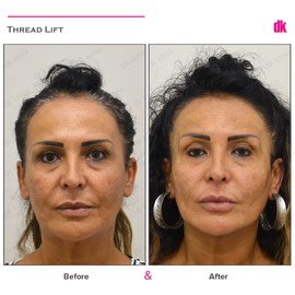 THREAD LIFT - Before and After