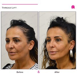 THREAD LIFT - Before and After