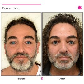 THREAD LIFT - Before and After