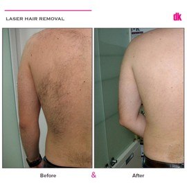 LASER HAIR REMOVAL - Male - Before and After