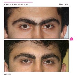 LASER HAIR REMOVAL - Male - Before and After