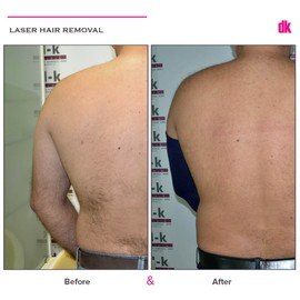 LASER HAIR REMOVAL - Male - Before and After