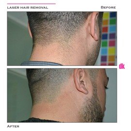 LASER HAIR REMOVAL - Male - Before and After