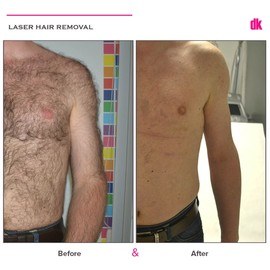 LASER HAIR REMOVAL - Male - Before and After