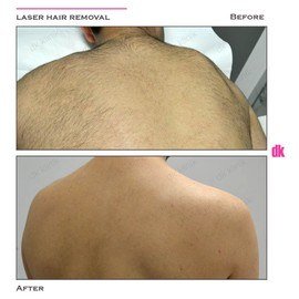 LASER HAIR REMOVAL - Male - Before and After
