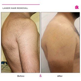 LASER HAIR REMOVAL - Male - Before and After
