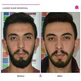 LASER HAIR REMOVAL - Male - Before and After