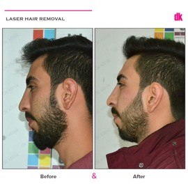 LASER HAIR REMOVAL - Male - Before and After