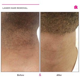 LASER HAIR REMOVAL - Male - Before and After