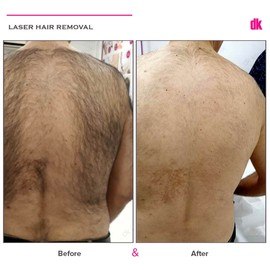 LASER HAIR REMOVAL - Male - Before and After