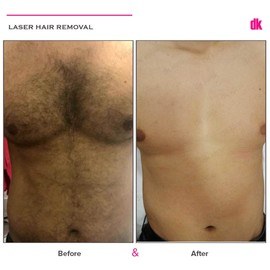 LASER HAIR REMOVAL - Male - Before and After