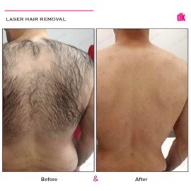LASER HAIR REMOVAL - Male - Before and After