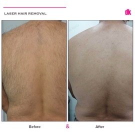 LASER HAIR REMOVAL - Male - Before and After