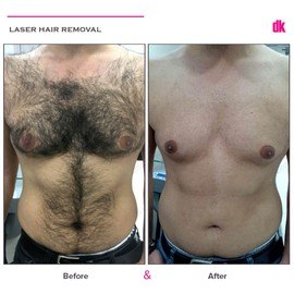 LASER HAIR REMOVAL - Male - Before and After
