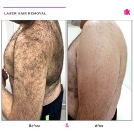 LASER HAIR REMOVAL - Male - Before and After