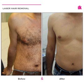 LASER HAIR REMOVAL - Male - Before and After