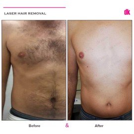 LASER HAIR REMOVAL - Male - Before and After