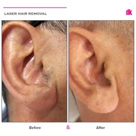 LASER HAIR REMOVAL - Male - Before and After